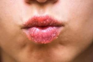 सर्दियों में रूखी त्वचा और फटे होंठों की देखभाल